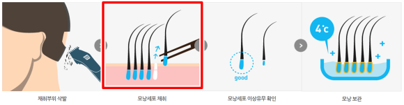 비절개 모발이식 흉터, 줄일 수 있는 노하우 1가지 관련 이미지 2