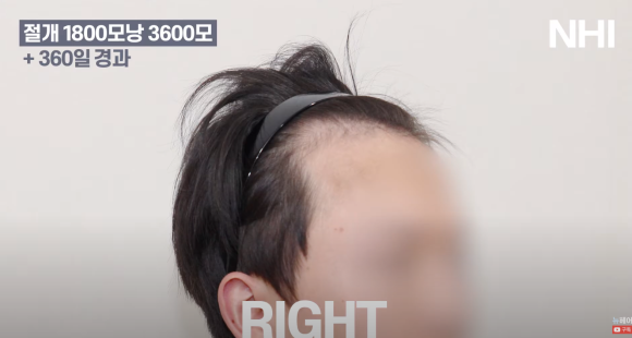 [뉴헤어] 모발이식 1800모낭(3600모) 1년 경과 사진 관련 이미지 4