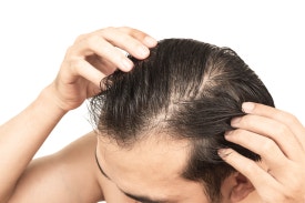 Stress-Related Hair Loss? Study Finds '59% Experienced It' image 2