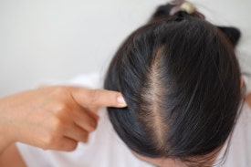 Stress-Related Hair Loss? Study Finds '59% Experienced It' image 1