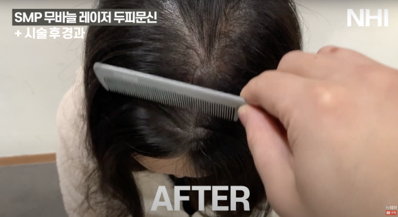 가르마 두피문신 후기 전후사진 l 여성 탈모치료 두피문신 관련 이미지 2
