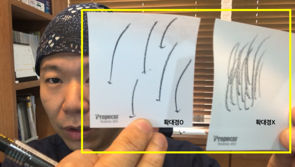 모발이식을 할 때 확대경은 필수일까? 관련 이미지 5