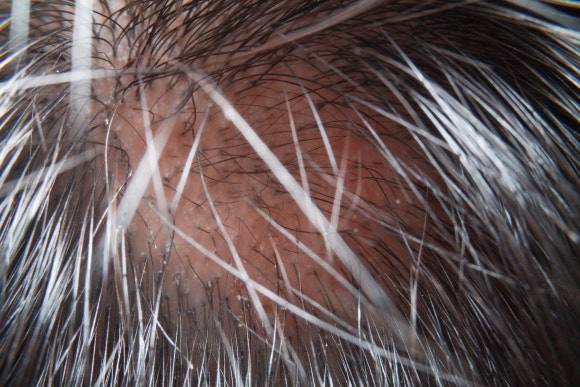 What Role Does Ritlecitinib Play in Research on Treating Alopecia Areata in Adolescents? image 1