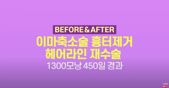 여자 이마축소술 흉터제거 모발이식 l 헤어라인교정 l 여자모발이식 관련 이미지 1