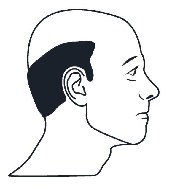모발이식 때 최대 몇 번 수술이 가능하고, 몇 모까지 뒷머리에서 뽑을 수 있나요? 관련 이미지 1