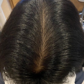 Hair Loss Treatment: Different Strategies by Area (When Combination Treatment Is Used) image 7