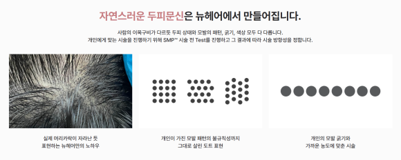 50대 남성 정수리 탈모, SMP 두피문신으로 극복하는 방법 관련 이미지 11