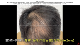 정수리탈모문신 시술직후 나타나는 효과?(전후사진) 관련 이미지 9