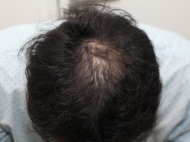 Why Are Crown Hair Transplants (Part-Line Hair Transplants) Slower to Show Results Than Other Areas? image 2