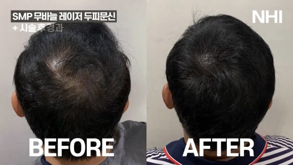 두피문신 전후사진 ㅣ뉴헤어 ㅣ 강남두피문신 관련 이미지 2
