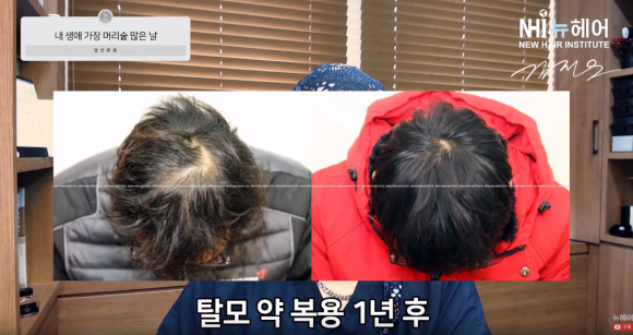 탈모 치료는 ASAP? 늦었다고 생각할 때가 정말 늦었다 관련 이미지 2