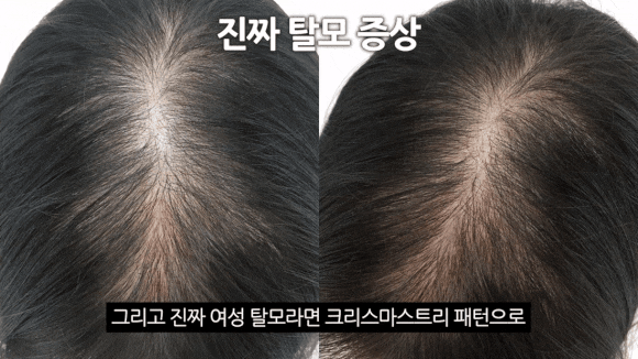 탈모 진단 병원, 초기 증상과 예방법 정리 관련 이미지 7