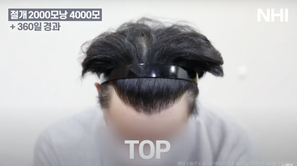 뉴헤어 남자 모발이식 후기(2000모낭) 모발이식 1년 효과 후기 관련 이미지 6