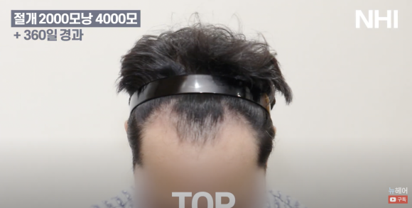 [뉴헤어] 남자 모발이식 2000모낭(4000모) 전후 비교 l 엠자이마 l 탈모 관련 이미지 6