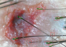 Why Hair Loss Diagnoses Differ by Clinic: What Are the Differences? image 2