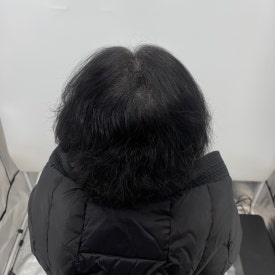 여성두피문신? 60대 실제 사례 사진으로 확인하세요 관련 이미지 9