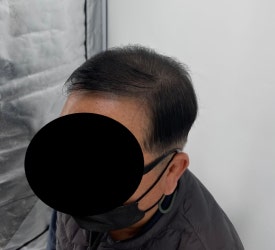 두피문신후기, 60대 남성 사례 전부 공개합니다 관련 이미지 11