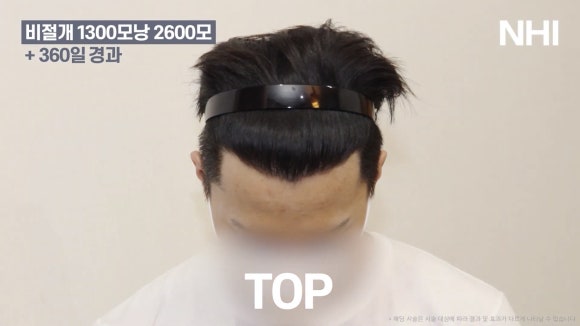 모발이식 전후 사진 l 1년 후ㅣ뉴헤어 1300모낭 관련 이미지 5