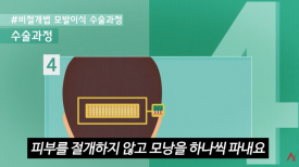 모발이식 절개&middot;비절개보다 중요한 것은? 결과를 좌우하는 5가지 관련 이미지 3