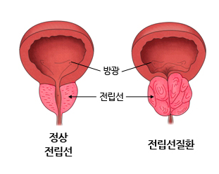 What Is the Relationship Between Taking Hair Loss Medication and PSA Levels (Prostate-Specific Antigen), and Prostate Examinations? image 2