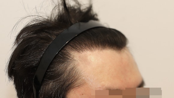 Hair Loss Treatment: Different Strategies by Area (When Combination Treatment Is Used) image 4