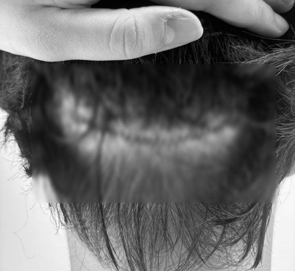 Recovery After Hair Transplant Surgery: Is It Okay to Bend Your Head Down? (Precautions by Recovery Stage) image 1