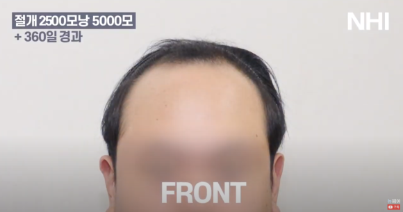 넓은 이마 모발이식 l 탈모 모발이식 후기 사진 관련 이미지 2