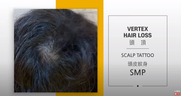 두피문신 전후 비교 사진과 영상 l 두피문신 관련 이미지 3