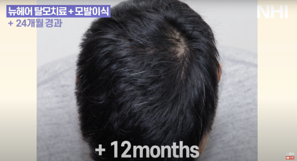 정수리 탈모 치료 l 탈모치료 후기ㅣ모낭주사 효과 1년 후 관련 이미지 3