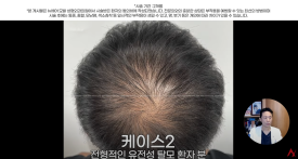 정수리탈모문신 시술직후 나타나는 효과?(전후사진) 관련 이미지 16