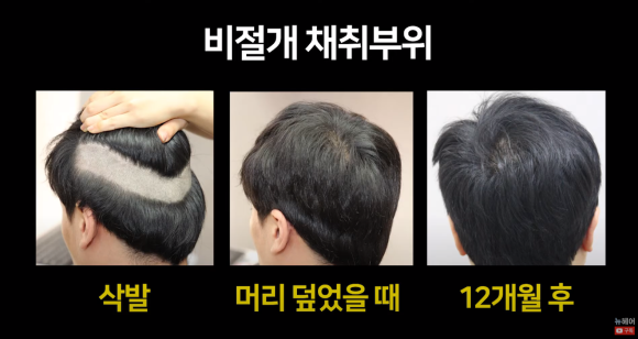 [뉴헤어] 모발이식 후 출근할 때 티 많이 나나요? ㅣ 회복 시간 관련 이미지 15