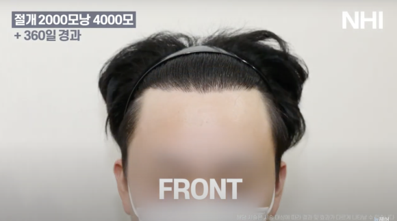 뉴헤어 남자 모발이식 후기(2000모낭) 모발이식 1년 효과 후기 관련 이미지 2