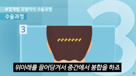 A Complete Guide to Non-Incisional Hair Transplant Methods image 6
