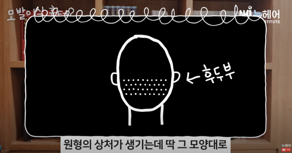 모발이식 흉터 정리 끝! 비절개 & 절개 흉터 비교 관련 이미지 11