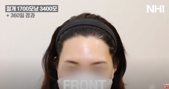 여자 이마 작아지는 헤어라인 교정 (모발이식) 1700모낭 1년 후 관련 이미지 3