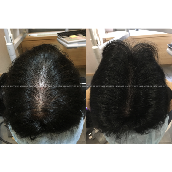 모낭주사 탈모치료 효과 1년 후 사진, 부작용은? 관련 이미지 1