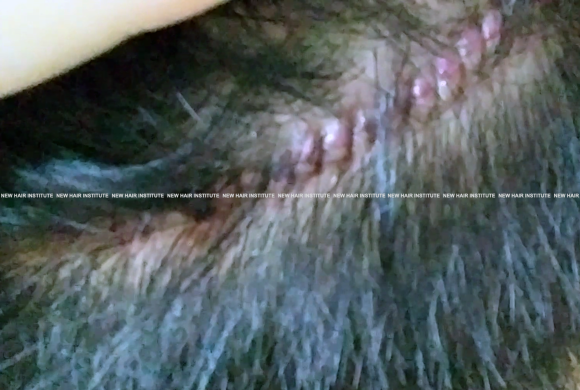 모발이식 절개 후 봉합 부분이 볼록볼록해요... 관련 이미지 2