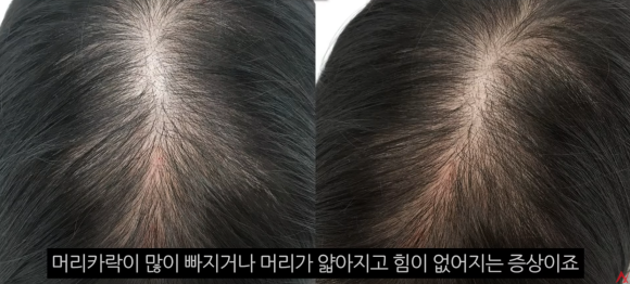 Female Hair Loss: What Symptoms Appear and How Should It Be Managed? image 1