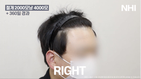 M자탈모(엠자탈모) 모발이식 1년 후 모습 공개 l 2000모낭(4000모) 관련 이미지 5