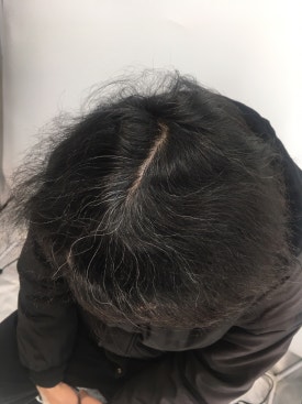 남성형 탈모 치료, 6개월 만에 이루어낸 변화 대공개 관련 이미지 6