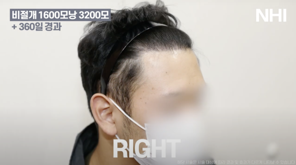 모발이식 비절개 1년 후기 전후사진 1600모낭 관련 이미지 4