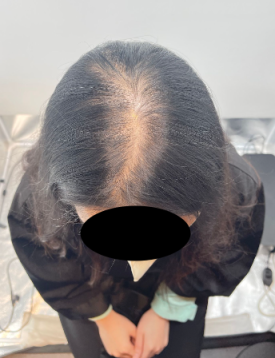 SMP후기, 두피문신 받고 자신감 회복한 30대 여성분 사례 관련 이미지 3