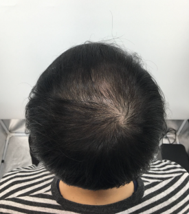 탈모치료주사? 효과 있을까 궁금하신 분들만 보세요 관련 이미지 11