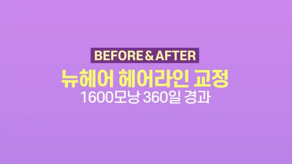 여자 모발이식을 통한 이마축소 l  1600모낭 전후사진 관련 이미지 1