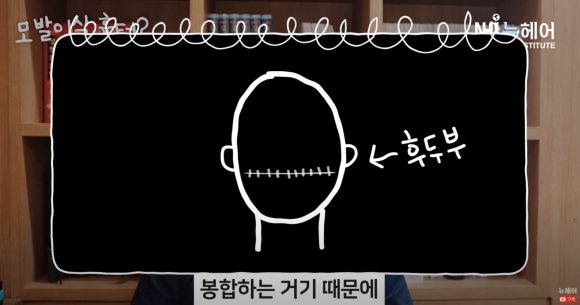 모발이식 흉터 정리 끝! 비절개 & 절개 흉터 비교 관련 이미지 8