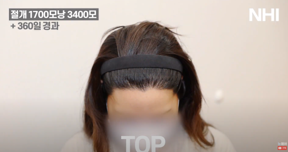 여자 이마 작아지는 헤어라인 교정 (모발이식) 1700모낭 1년 후 관련 이미지 7