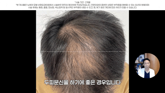 정수리탈모문신 시술직후 나타나는 효과?(전후사진) 관련 이미지 11
