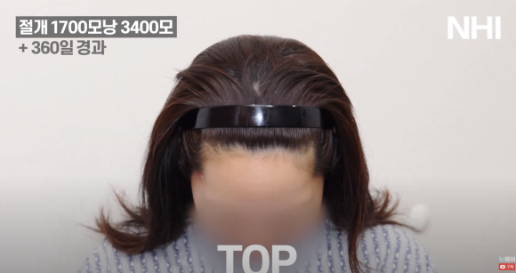 여자 이마 작아지는 헤어라인 교정 (모발이식) 1700모낭 1년 후 관련 이미지 6