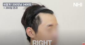 비절개 모발이식 헤어라인 엠자채우기 l 남자 탈모 모발이식 2400모 전후 사진 후기 관련 이미지 3