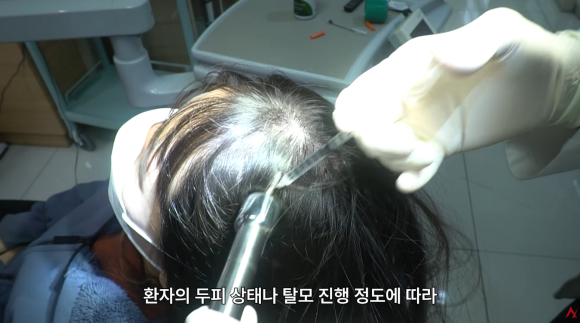 What Are the Effects and Side Effects of Follicular Injections? image 6